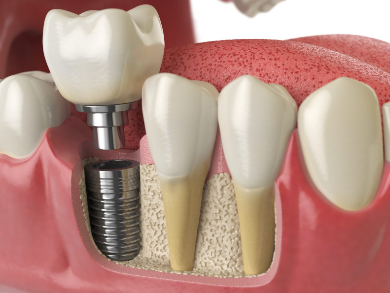 Dental Implants