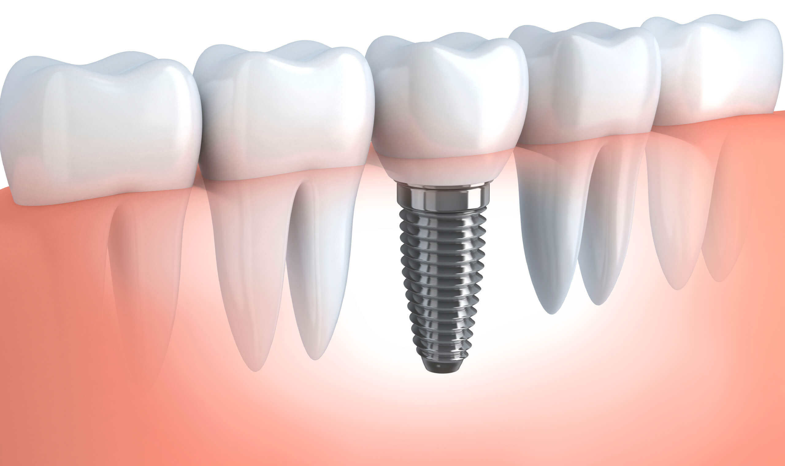 dental implants